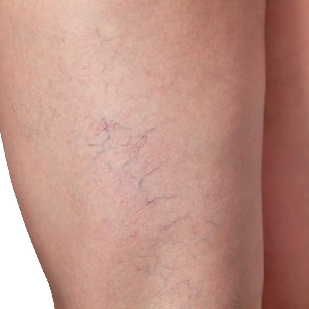 What We Treat - Spider Veins
