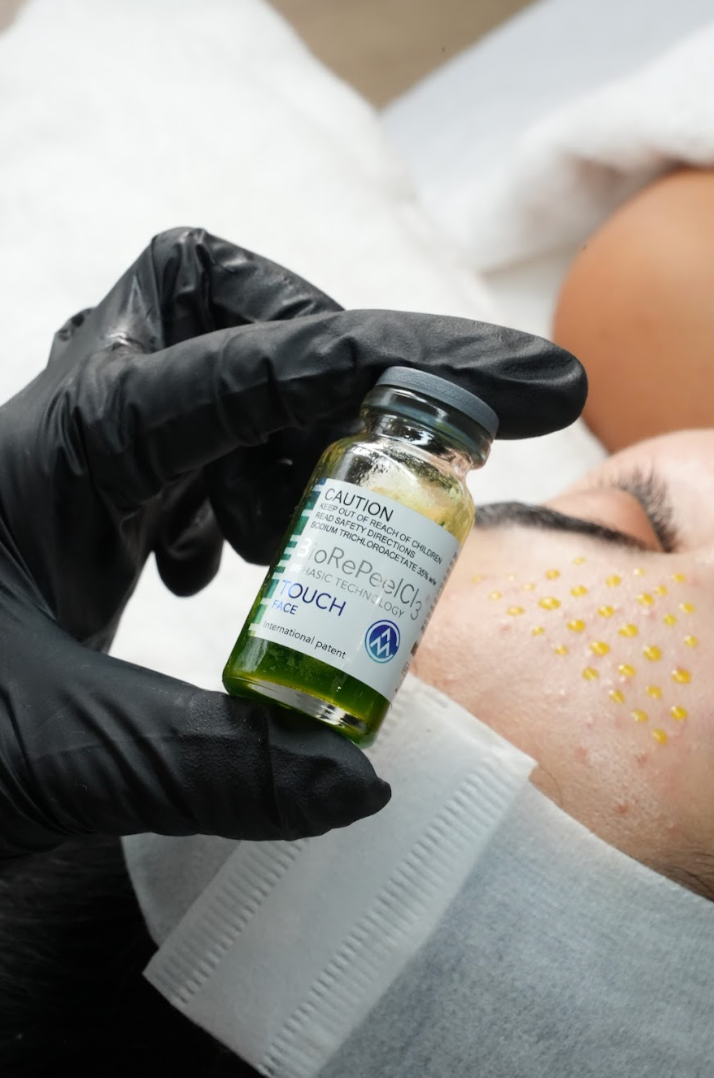 TCA Peels for Acne Scarring