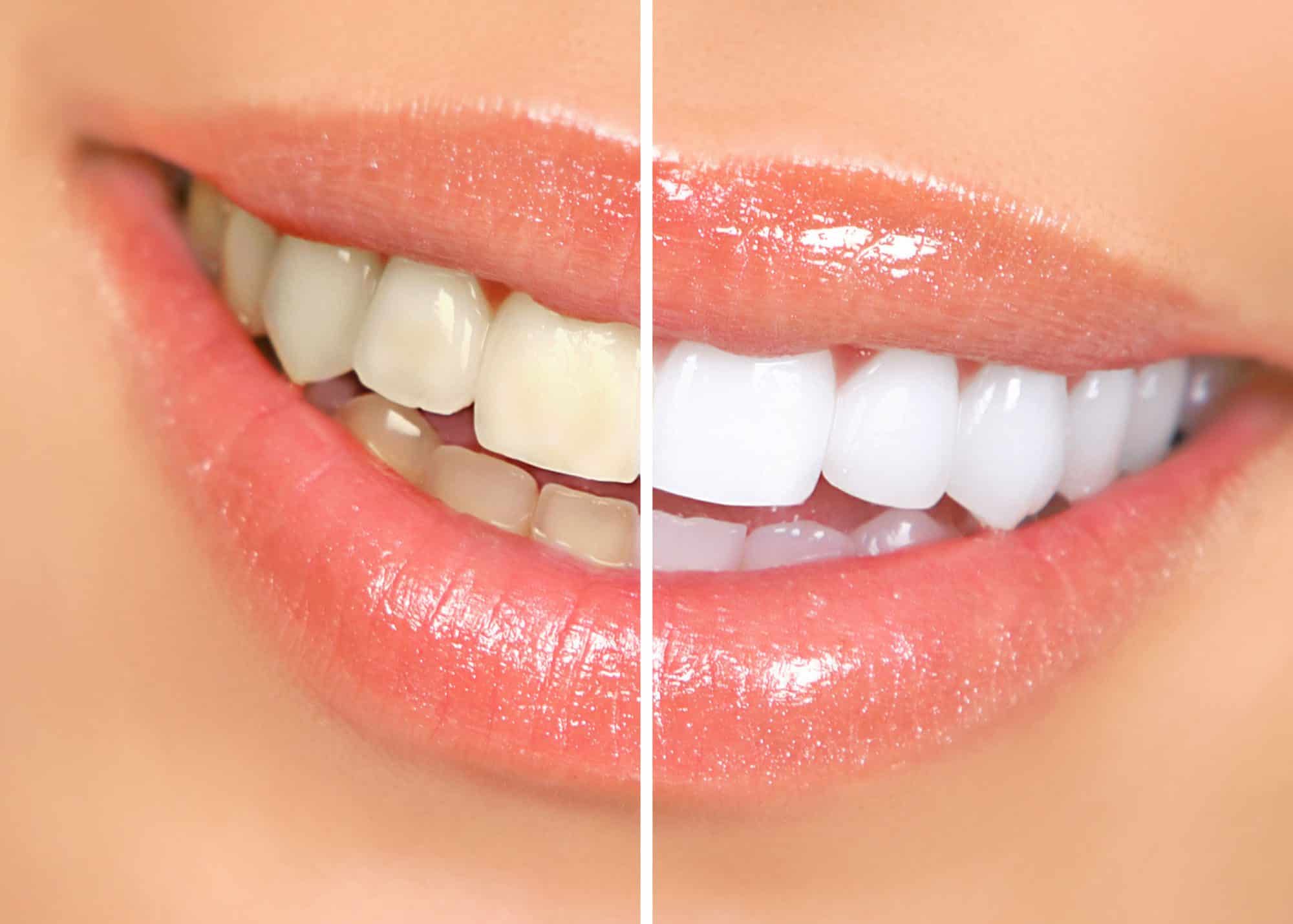 teeth-whitening-1.jpg
