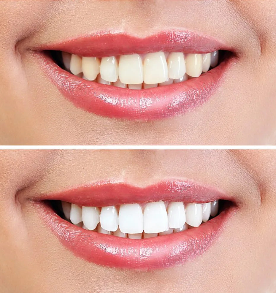 teeth-whitening-before-and-after-930x987.webp